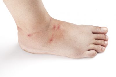 Bedbugs Cause Discomfort and Itching!