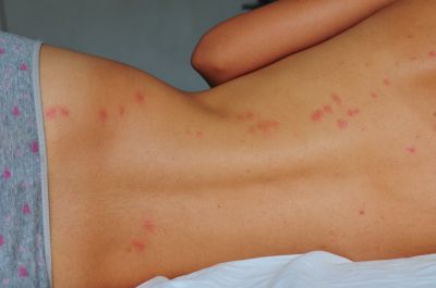 Get Better Sleep by Removing Bedbugs!